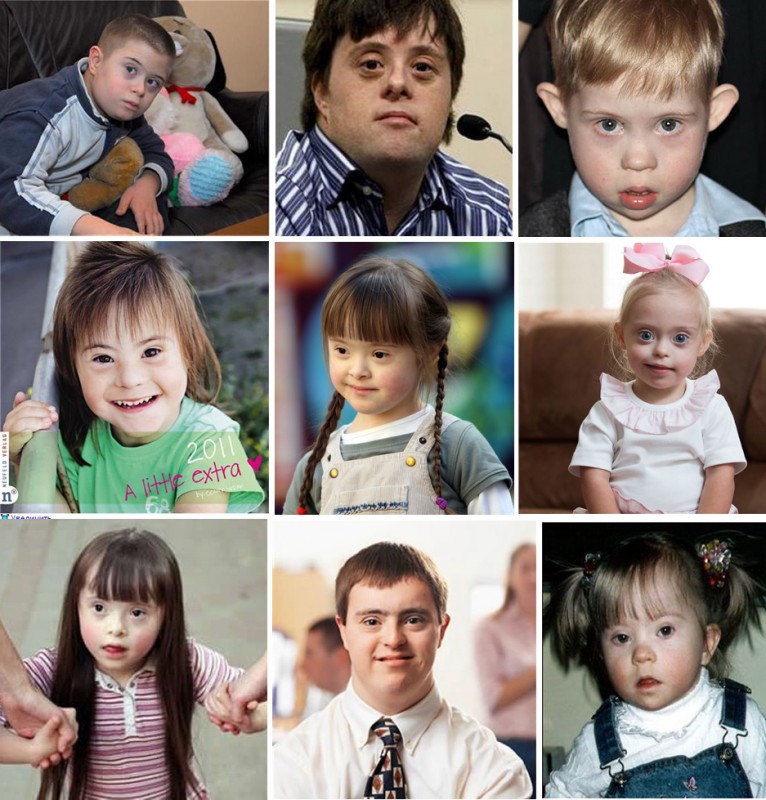 Одинаковое лицо даунов. Дети с синдромом Дауна похожи. Люди с синдромом Дауна похожи. Люди с синдромом Дауна разных национальностей.