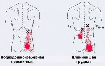 Карта точек боли в теле и точек напряжения мышц (триггеры)