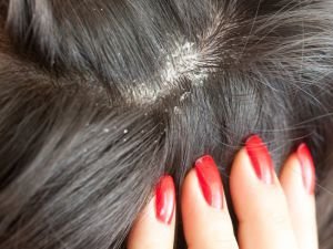 Жирная перхоть