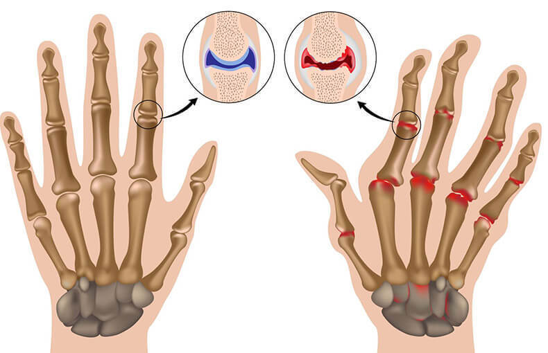 Артрит пальцев рук: 7 натуральных средств, которые успокоят его симптомы