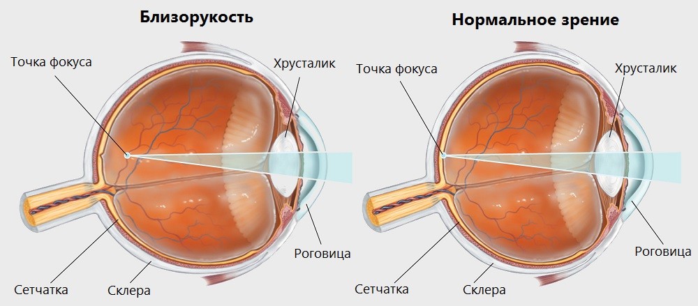 Близорукость (миопия)