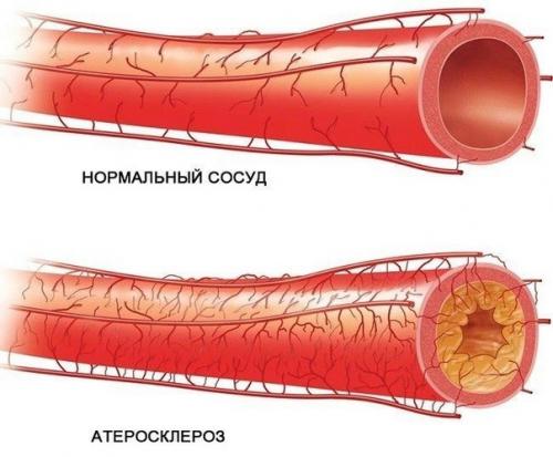 Лечение атеросклероза народными средствами.