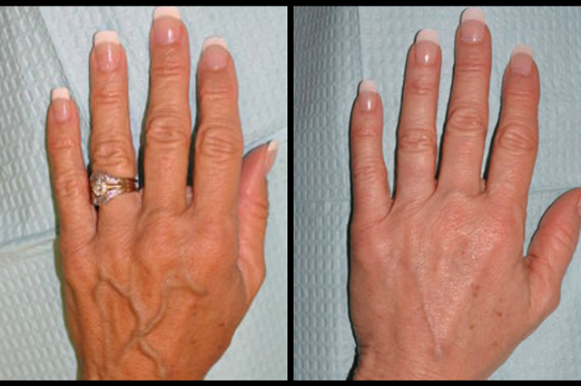 Инъекции, лазеры, пилинги: как ухаживать за руками зимой Инъекции, лазеры, пилинги: как ухаживать за руками зимой новости красоты