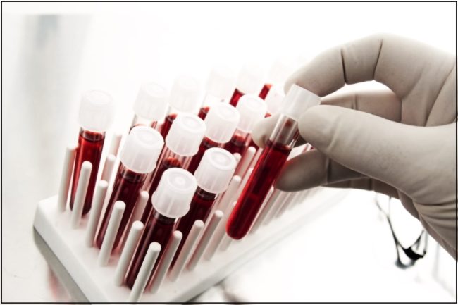 Причины вязкости крови у человека. Как определить показатель вязкости крови, какой анализ сдать, расшифровка и нормы вязкость крови,здоровье,медицина