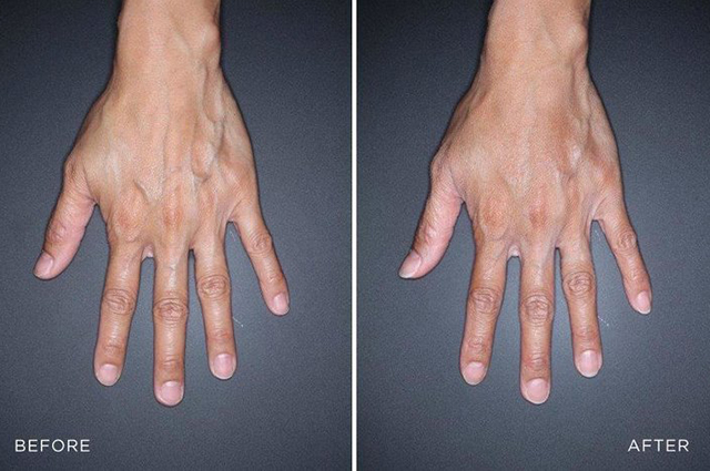 Инъекции, лазеры, пилинги: как ухаживать за руками зимой Инъекции, лазеры, пилинги: как ухаживать за руками зимой новости красоты