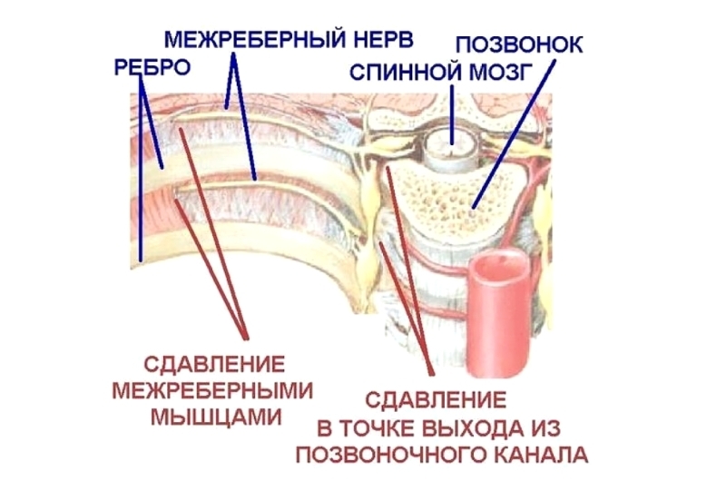 Межреберная невралгия: что делать здоровье и медицина,невралгия