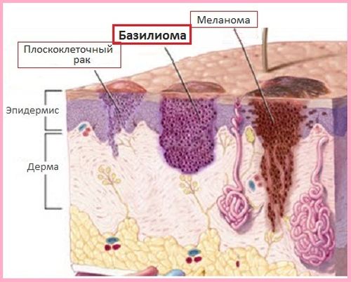 Симптомы базалиомы