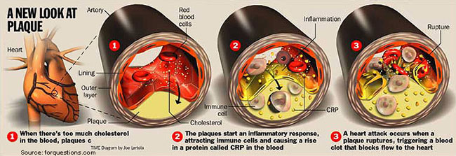 bad-cholesterol