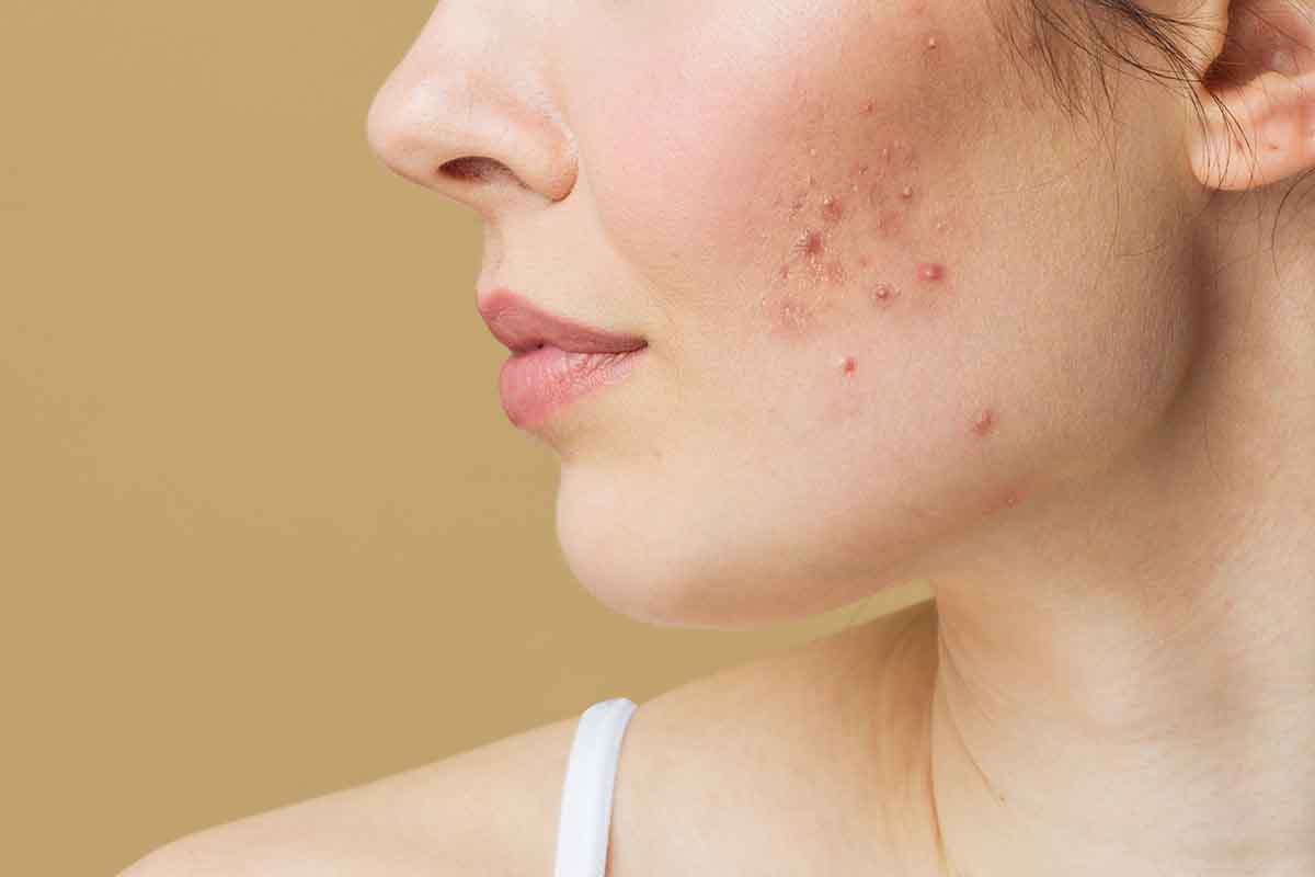 Understanding Acne: Common Causes, Triggers, and Types of Acne