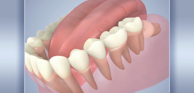 Болит горло после удаления зуба мудрости: причины, врачебное наблюдение и лечение