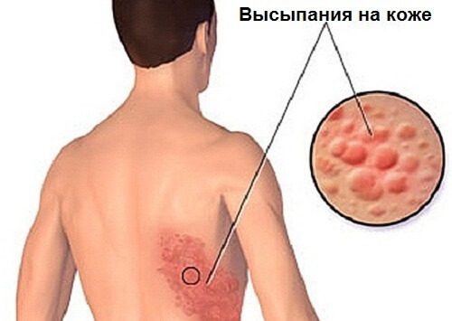 Лечение опоясывающего лишая натуральными средствами