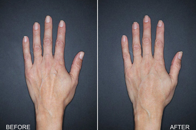 Инъекции, лазеры, пилинги: как ухаживать за руками зимой Инъекции, лазеры, пилинги: как ухаживать за руками зимой новости красоты