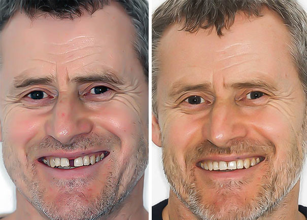 Фото лечение брекетами до и после фото
