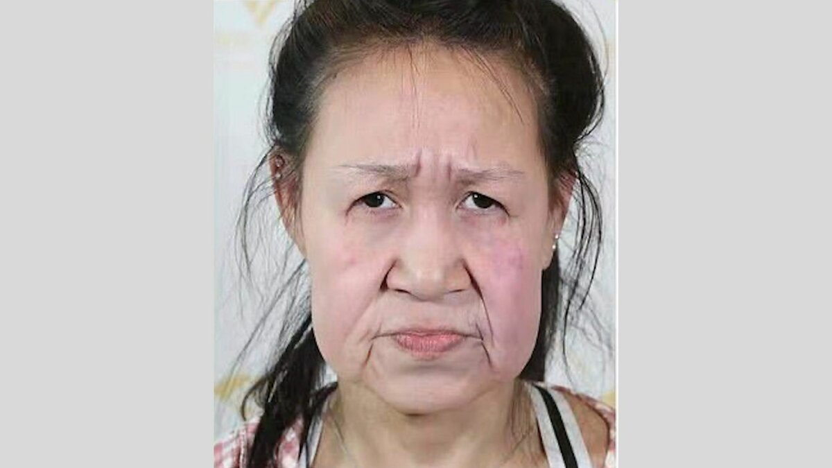 15-летняя школьница с лицом бабушки после пластики стала красавицей болезни,медицина,пластическая хирургия