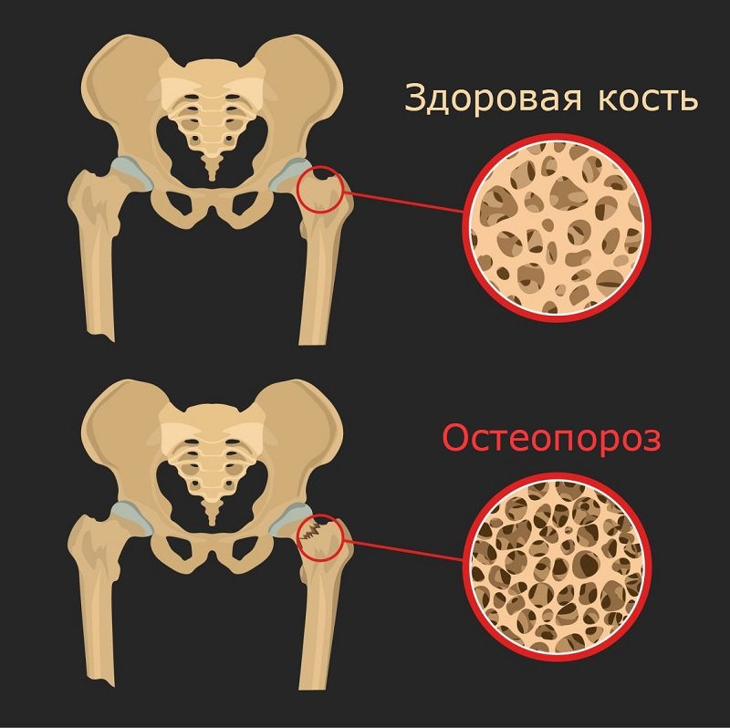 Признаки остеопороза кальция, костной, костей, ткани, остеопороза, больше, остеопороз, кости, только, плотности, витамина, нужно, продукты, всего, остеопорозе, витаминов, является, этого, количество, можно