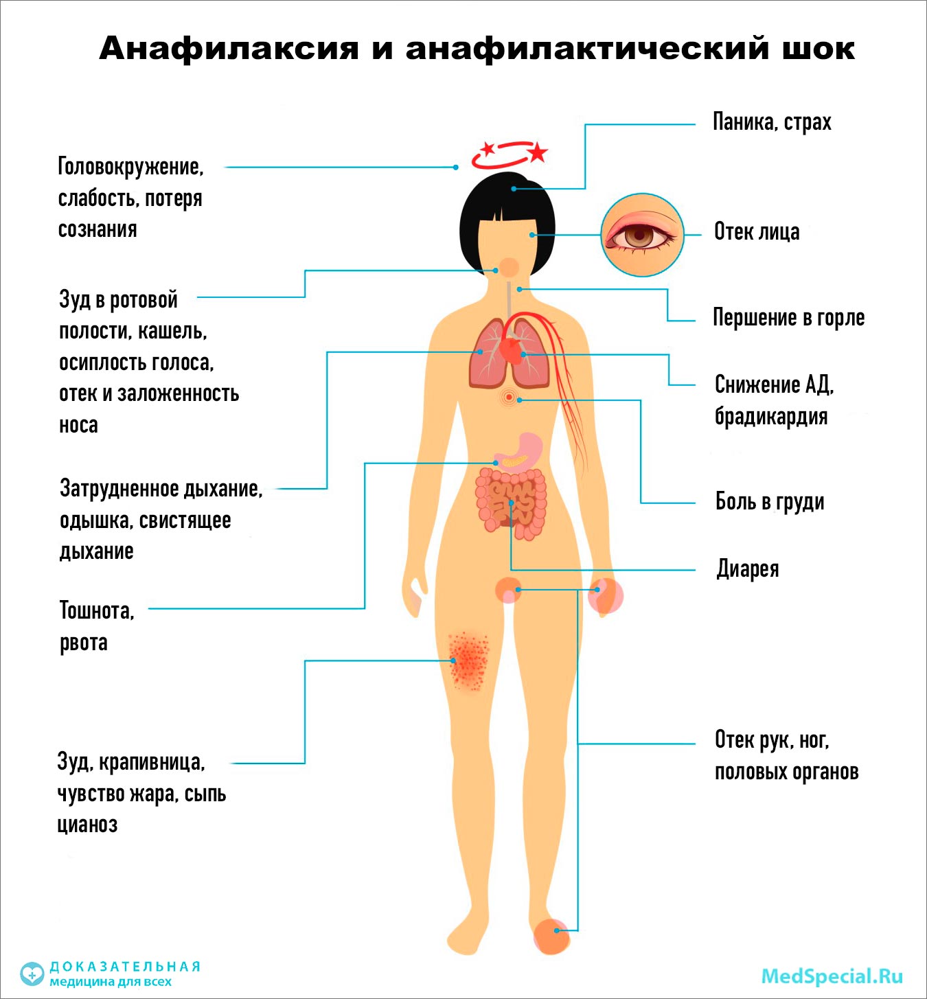 Анафилактический шок и анафилаксия. Термины и определения аллергическая реакция,анафилаксия,анафилактический шок,здоровье,медицина