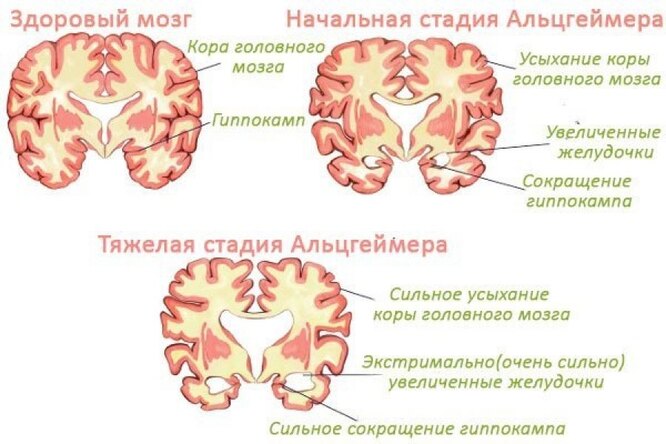 Что такое болезнь Альцгеймера и почему ей болеет так много людей Альцгеймера, клетки, мозга, заболевания, медицина, деменция, которые, также, болезни, ацетилхолина, эффективно, возникновения, число, терапии, в мозговых, органический, и полисахаридов, этого, в организме, момент