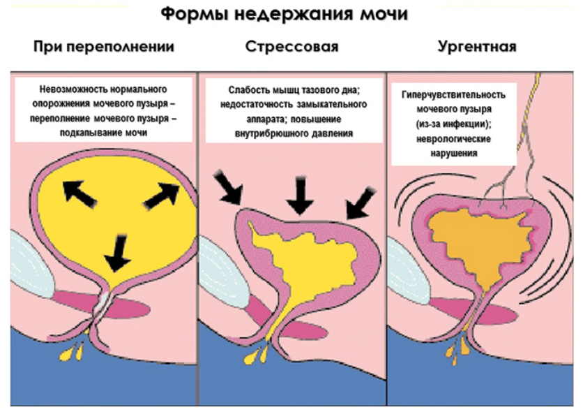 Недержание мочи: народные рецепты лечения и советы врача. Не терпи и не молчи - мочевой пузырь лечи!