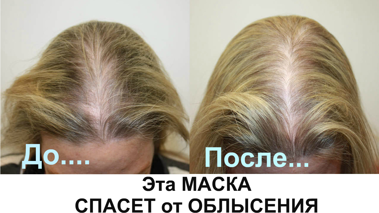 Выпадение волос после маски. Мезотерапия волос до и после. Выпадение волос до и после. Редкие волосы у женщин.