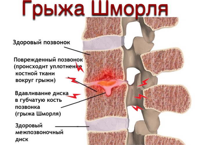 грыжа Шморля