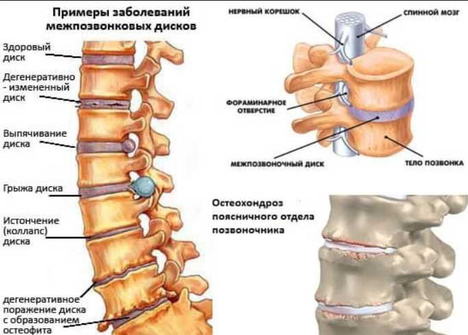 Опасный остеохондроз: какие лекарства и народные средства помогут исцелиться