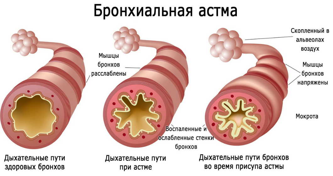 Лечение бронхиальной астмы народными средствами