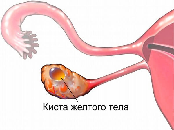 Киста желтого тела в яичнике. 