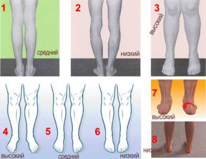 Нормальное положение стопы. Правильное положение стопы. Пронация и супинация стопы. Плоскостопие у детей. Эквинусная деформация стопы.