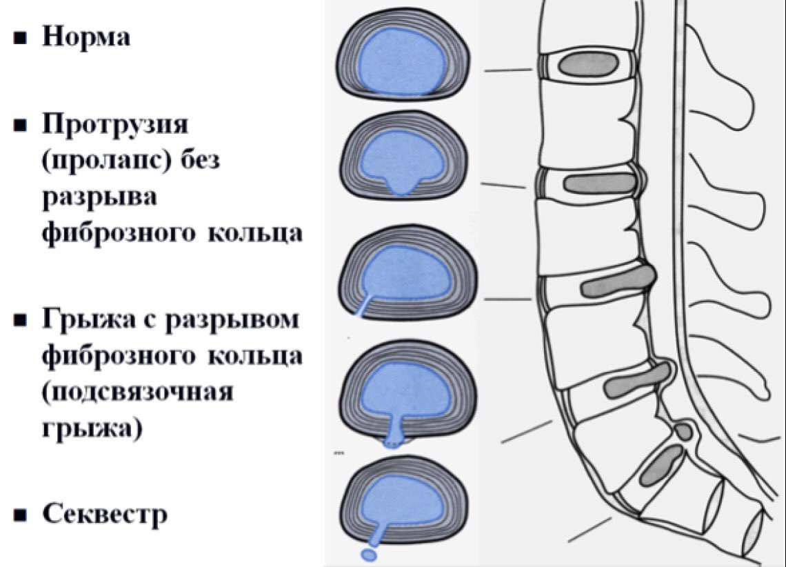 грыжа Шморля