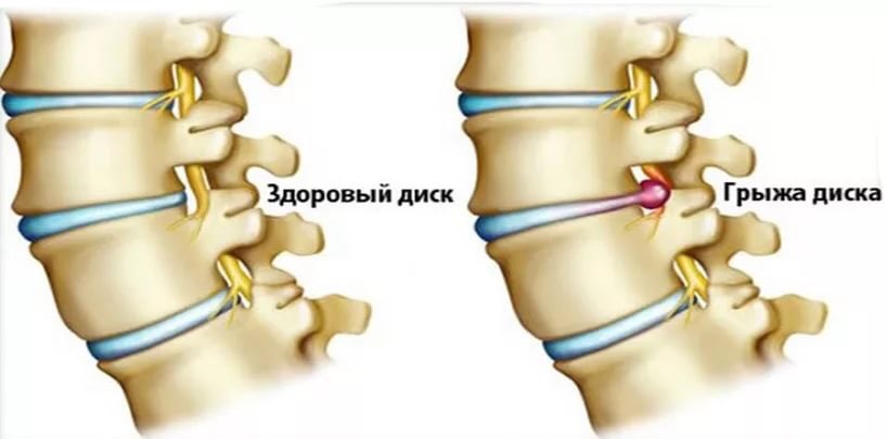 грыжа Шморля