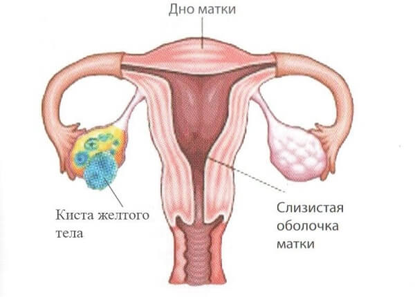 Киста желтого тела. 