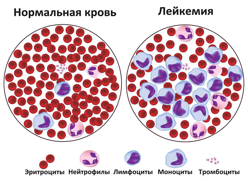 ВАЖНО! 16 признаков лейкемии, о которых необходимо знать ВАЖНО! 16 признаков лейкемии, о которых необходимо знать
