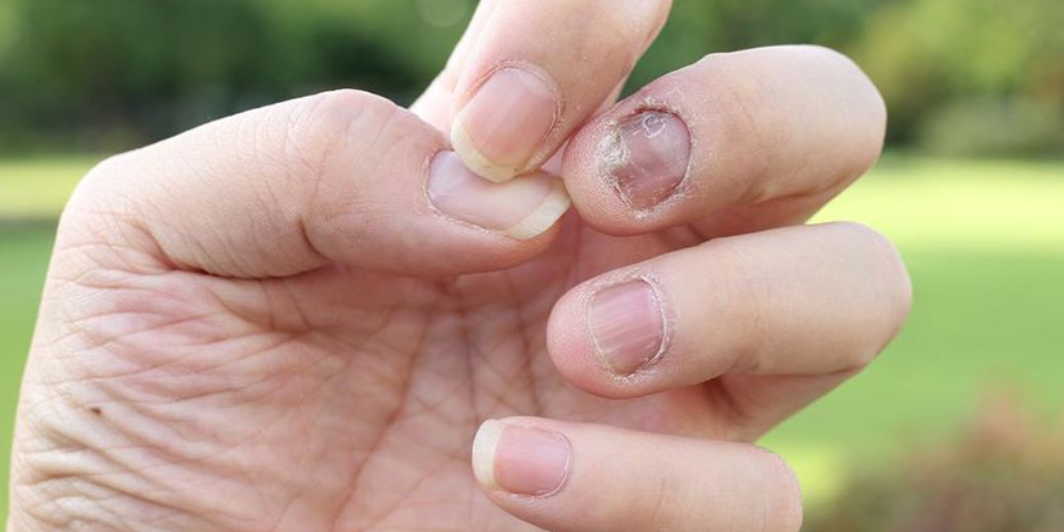 Как я вылечила ногтевой грибок