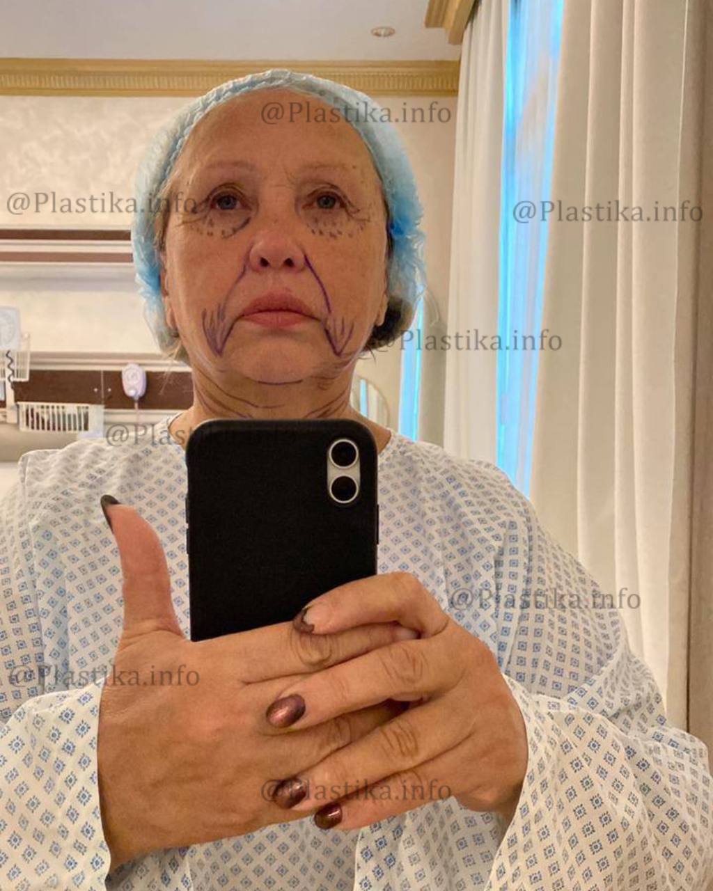 Фильм ужасов: фото матери Виктории Бони после пластики попали в Сеть – шрамы и ожоги