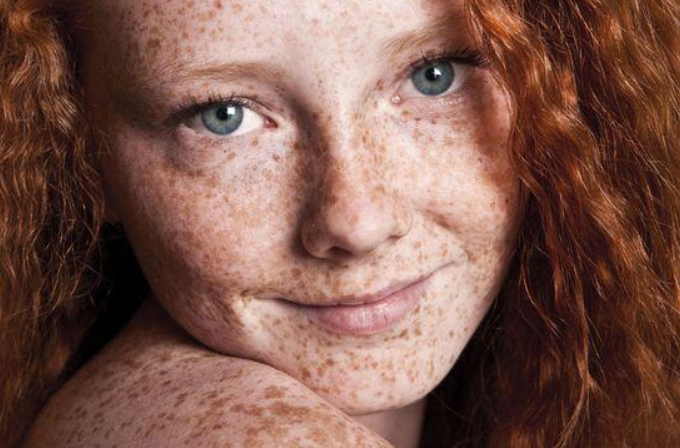 Если веснушки надоели - народные методы осветления веснушек и пигментных пятен и врачебные назначения