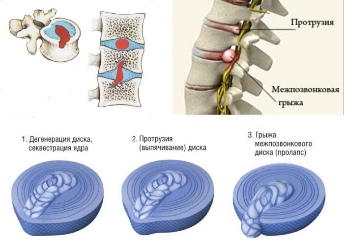 Грыжа межпозвоночного диска и грыжа Шморля болезни,грыжа межпозвоночного диска,грыжа Шморля,здоровье,медицина