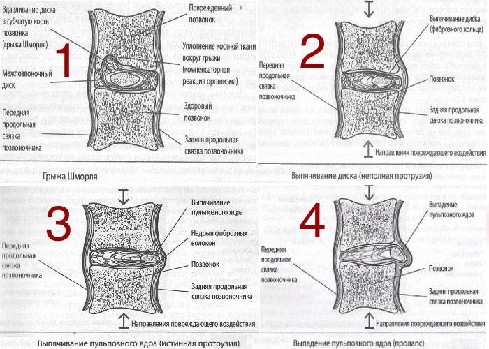 Грыжа межпозвоночного диска и грыжа Шморля болезни,грыжа межпозвоночного диска,грыжа Шморля,здоровье,медицина