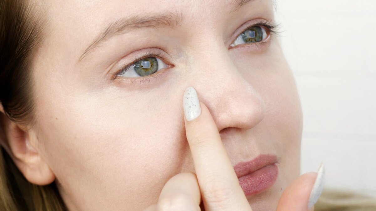 Как легко  убрать носослезную борозду и припухлости под глазам