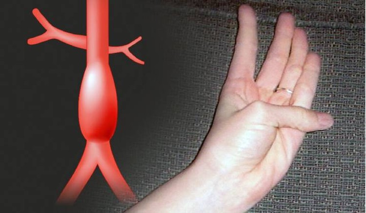 Тест на аневризму проще простого: растопырив пальцы, человек может узнать, не грозит ли ему внезапная смерть аневризма аорты,здоровье,медицина,тест