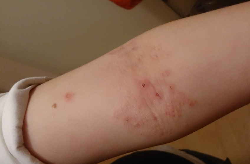 Нейродермит: тут не до шуток, лечением комплексным займитесь и грамотно пролечитесь. Рецепты применяйте, о зуде забывайте!