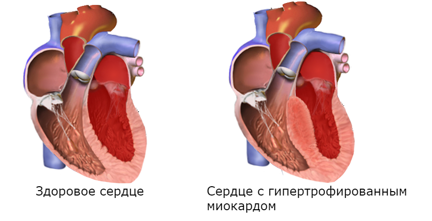 Глж сердца. Гипертрофированный миокард левого желудочка. Компенсаторная гипертрофия левого желудочка. Гипертрофированный миокард левого желудочка сердца. Физиологическая гипертрофия миокарда.
