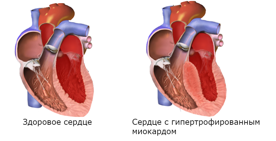 Функциональная гипертрофия. Гипертрофия левого желудочка сердца. Концентрическая гипертрофия миокарда. Гипертрофия миокарда сердца. Гипертрофия миокарда желудочков.