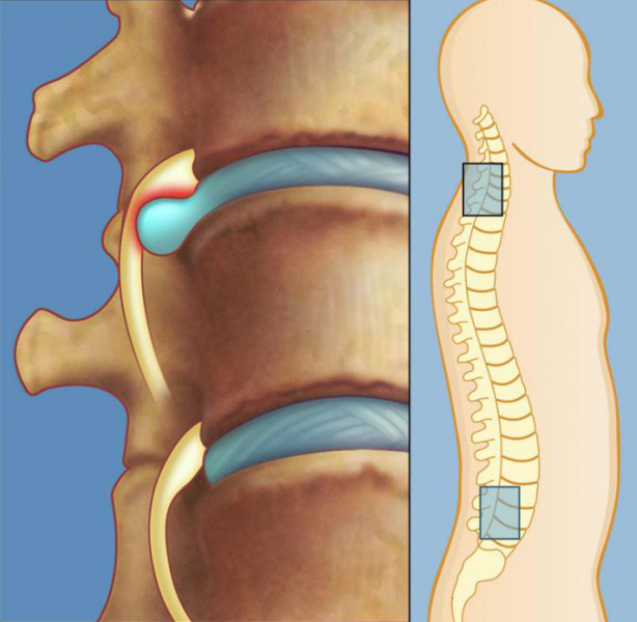 межпозвоночная грыжа