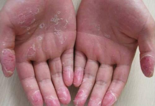 Шелушение кожи на руках. Причины появления трещин на руках