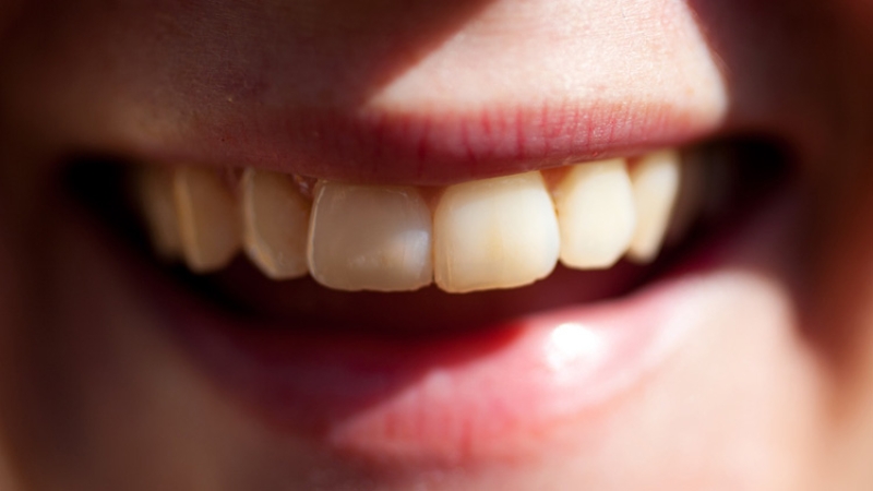 Ученые из США выяснили, как коллектив влияет на здоровье зубов человека