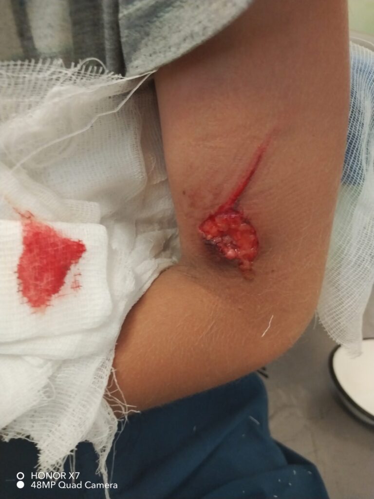 Ребёнок порвал руку на детской площадке в Лесопарке