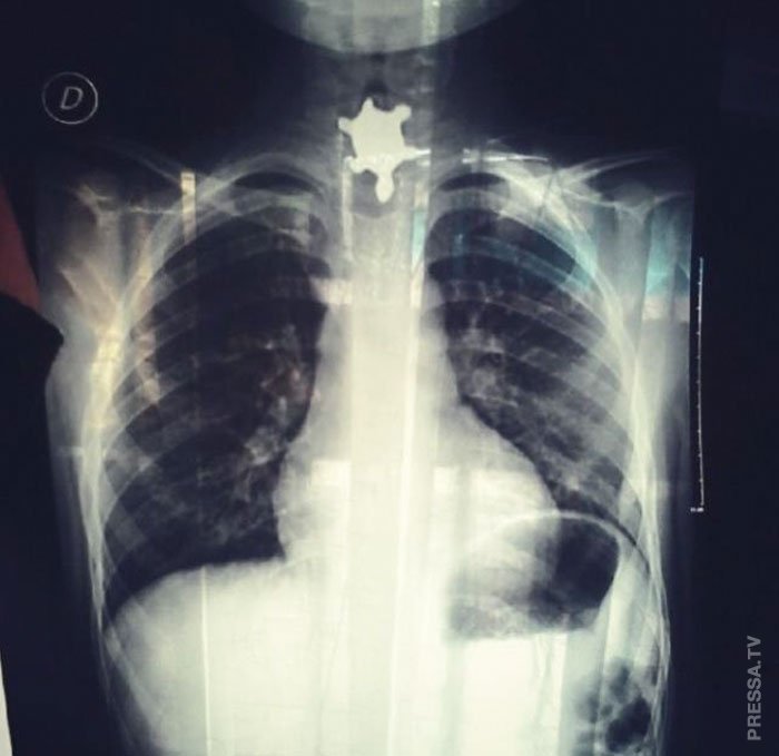 Люди рассказывают о своих самых глупых травмах 