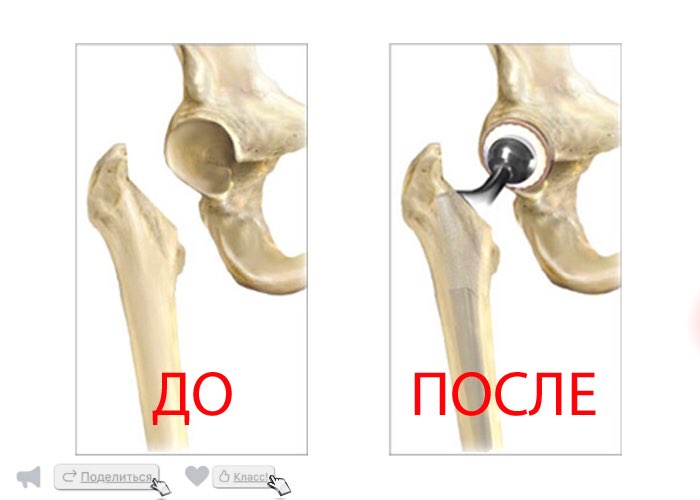 Перелом шейки бедренной кости: симптомы, диагностика, лечение шейки, бедра, кости, бедренной, перелома, может, пациентов, переломов, головки, тазобедренного, сустава, переломе, отломков, эндопротеза, пожилых, молодых, операции, более, осложнений, перелом