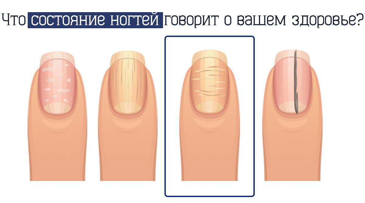 Как по ногтям определить заболевание организма фото человека
