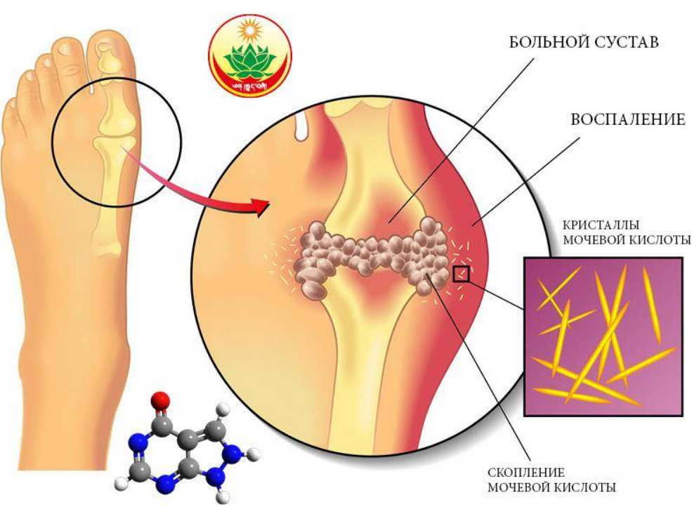 Народные рецепты очищения суставов и крови от солей мочевой кислоты - никакого остеохондроза, подагры и радикулита!
